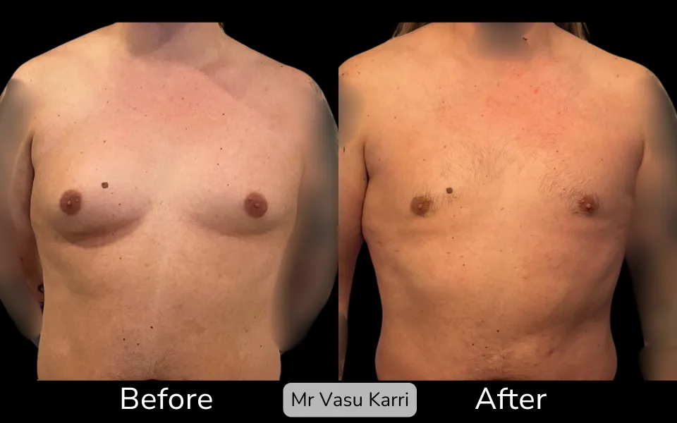 Before and after Gynaecomastia Surgery (Male Breast Reduction), patient 0.9