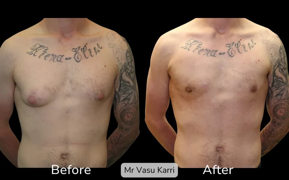 Before and after Gynaecomastia Surgery (Male Breast Reduction), patient 1