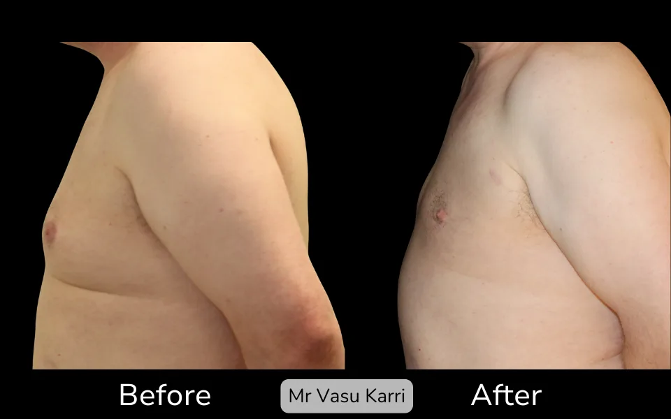 Before and after Gynaecomastia Surgery (Male Breast Reduction), patient 2