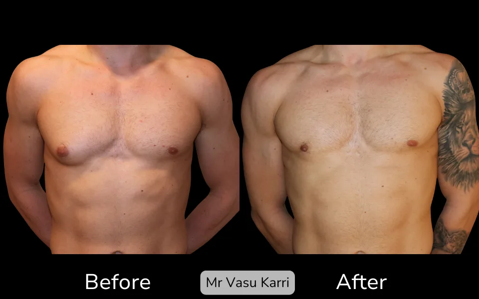 Before and after Gynaecomastia Surgery (Male Breast Reduction), patient 3