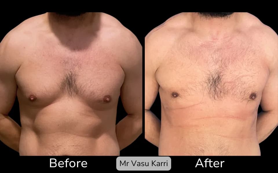 Before and after Gynaecomastia Surgery (Male Breast Reduction), patient 4