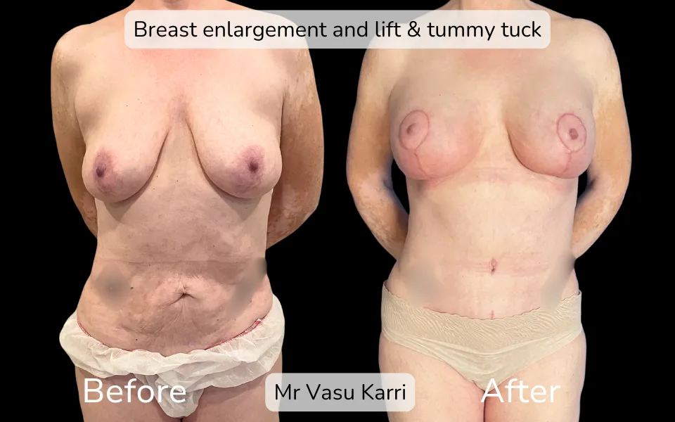 Before and after Mummy Makeover, patient 1
