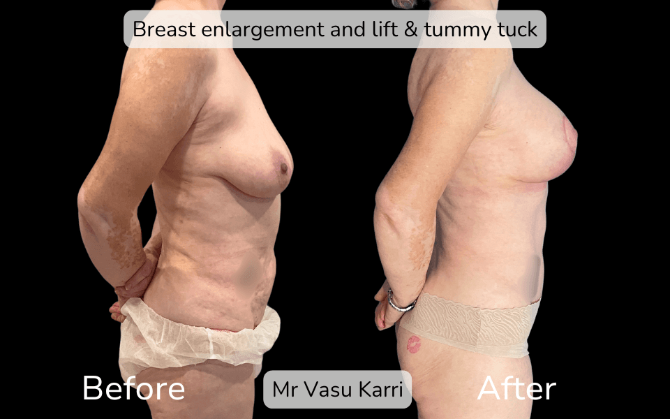 Mummy Makeover in Rotherham Before & After 2