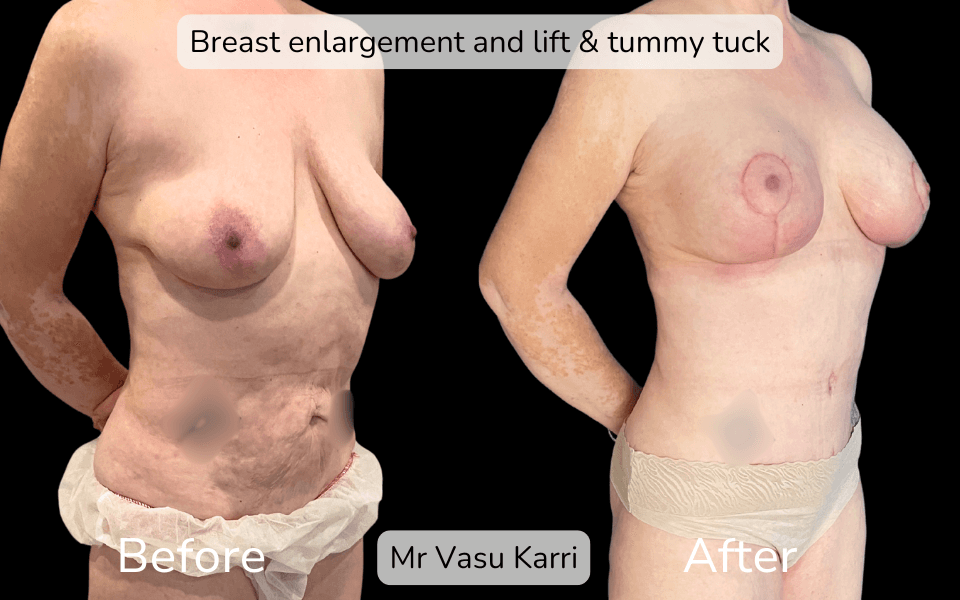 Mummy Makeover in Rotherham Before & After 3