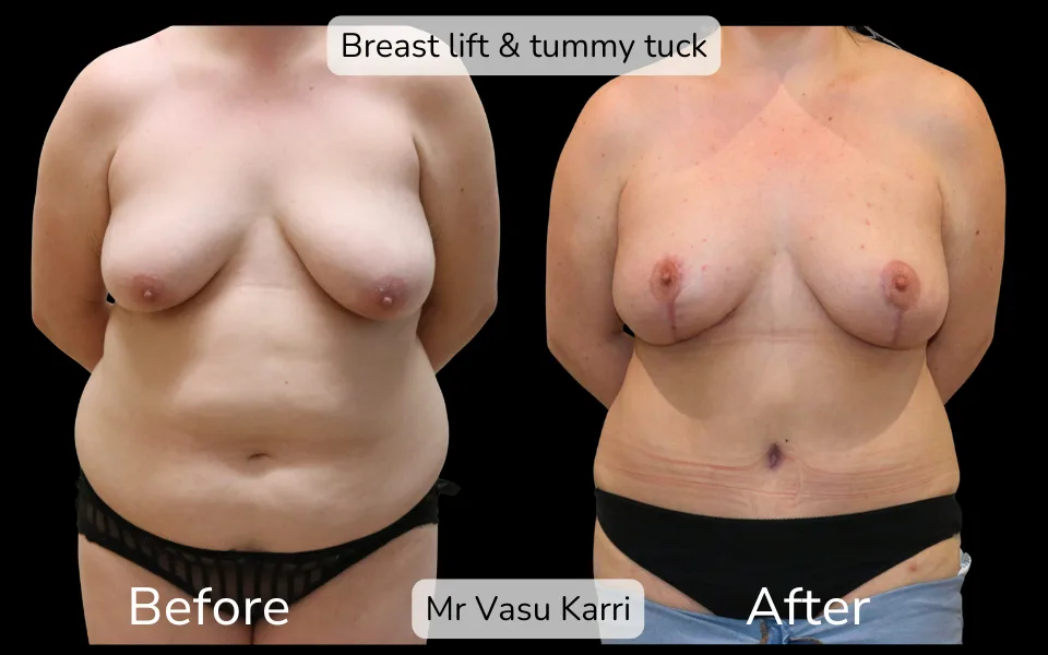 Before and after Mummy Makeover, patient 10