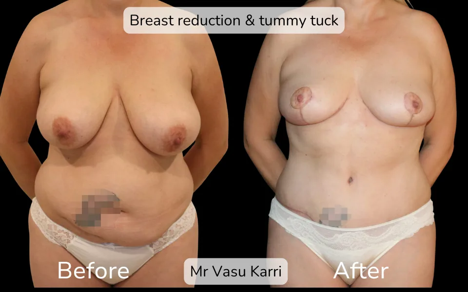 Before and after Mummy Makeover, patient 11