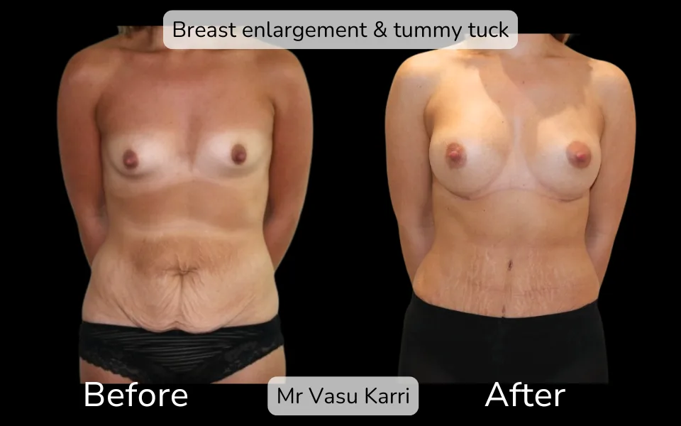 Before and after Mummy Makeover, patient 12