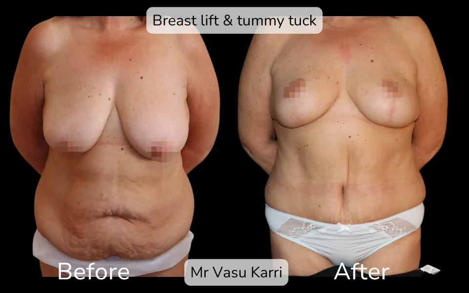 Before and after Mummy Makeover, patient 13