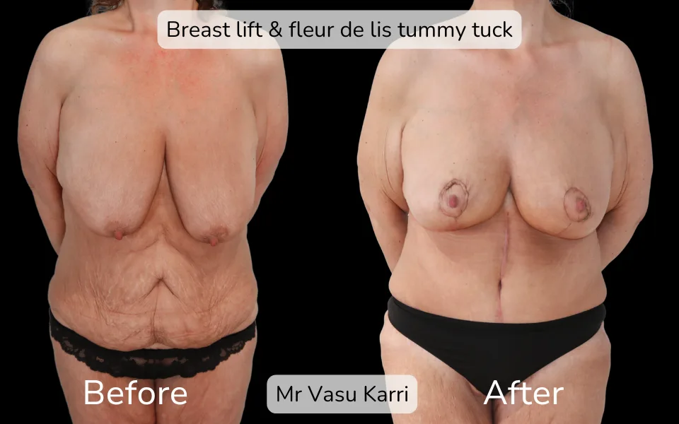 Before and after Mummy Makeover, patient 14