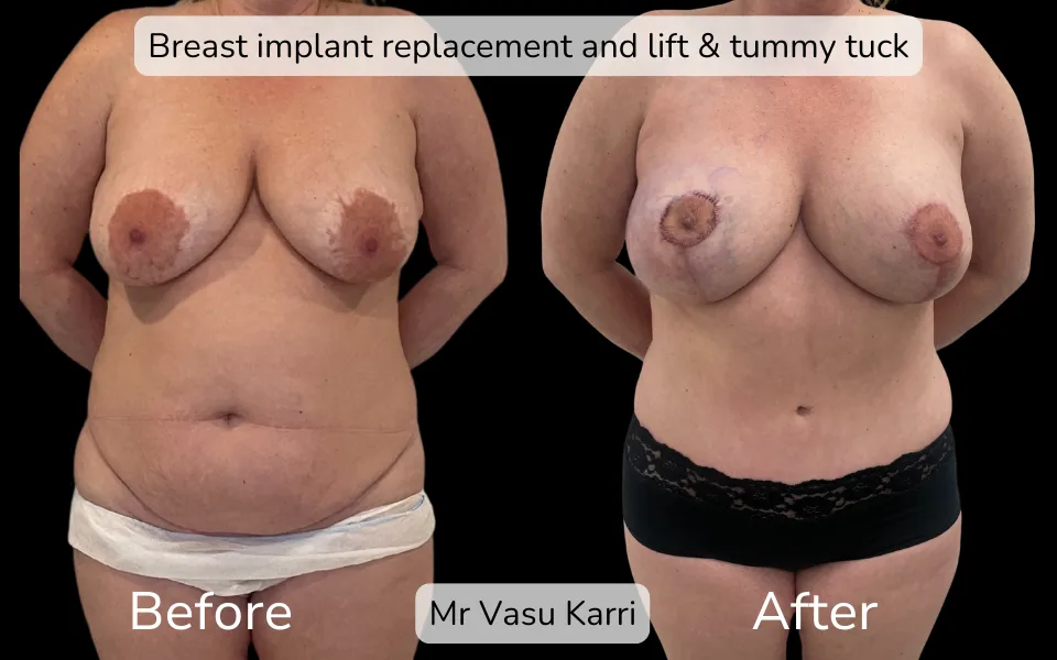 Before and after Mummy Makeover, patient 2