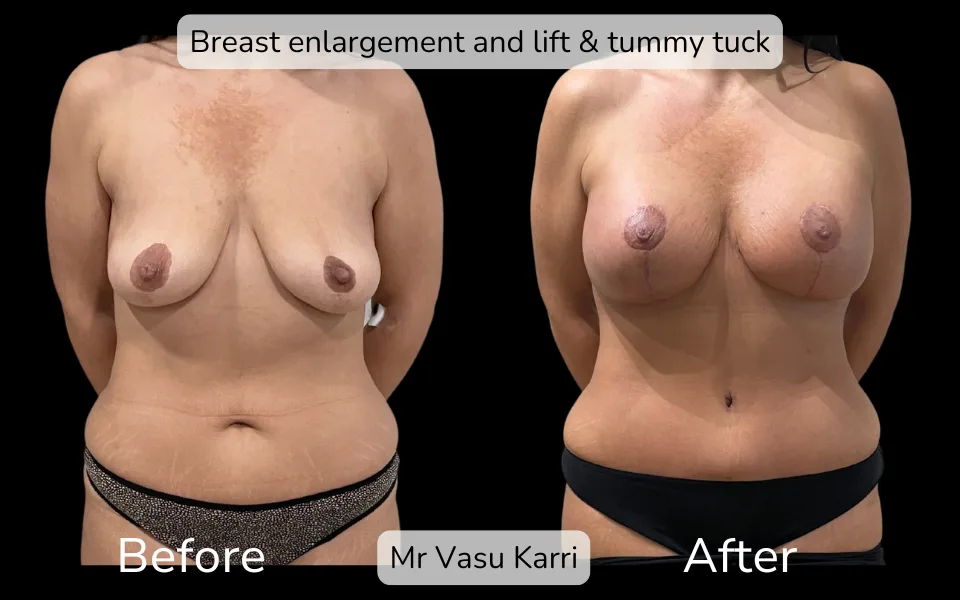 Before and after Mummy Makeover, patient 3