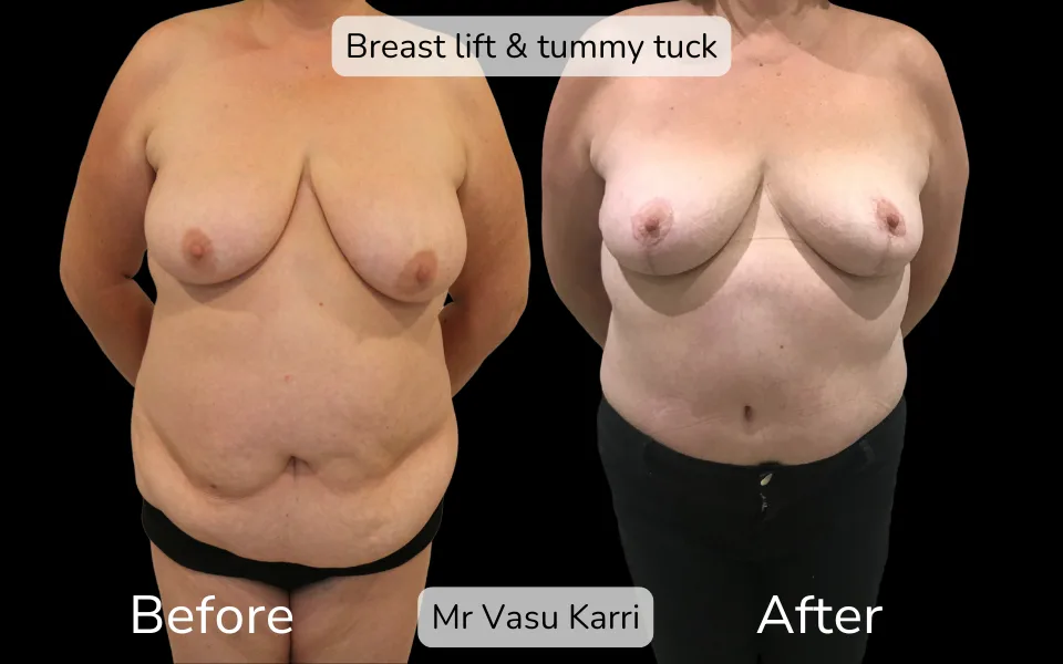 Before and after Mummy Makeover, patient 4