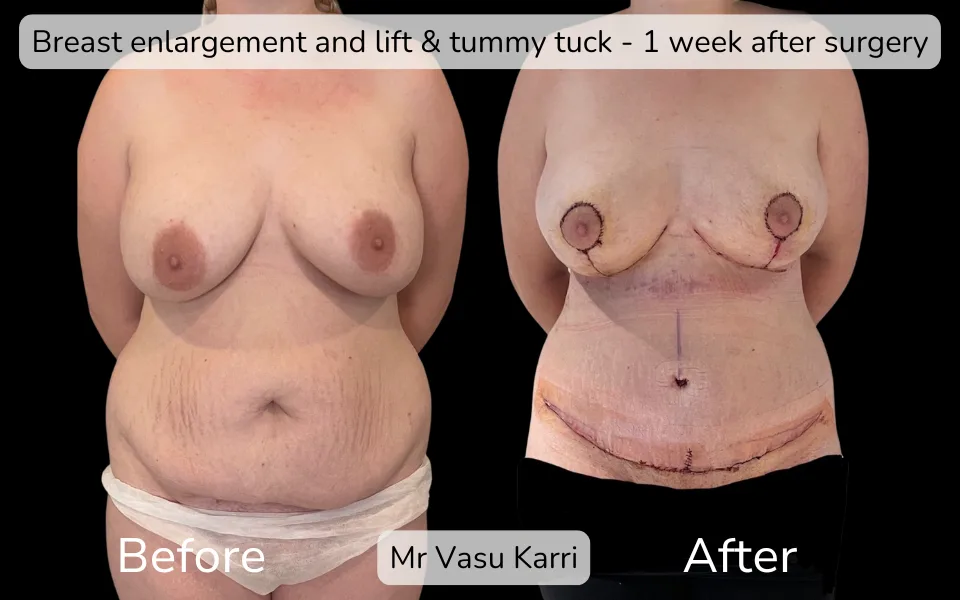 Before and after Mummy Makeover, patient 5