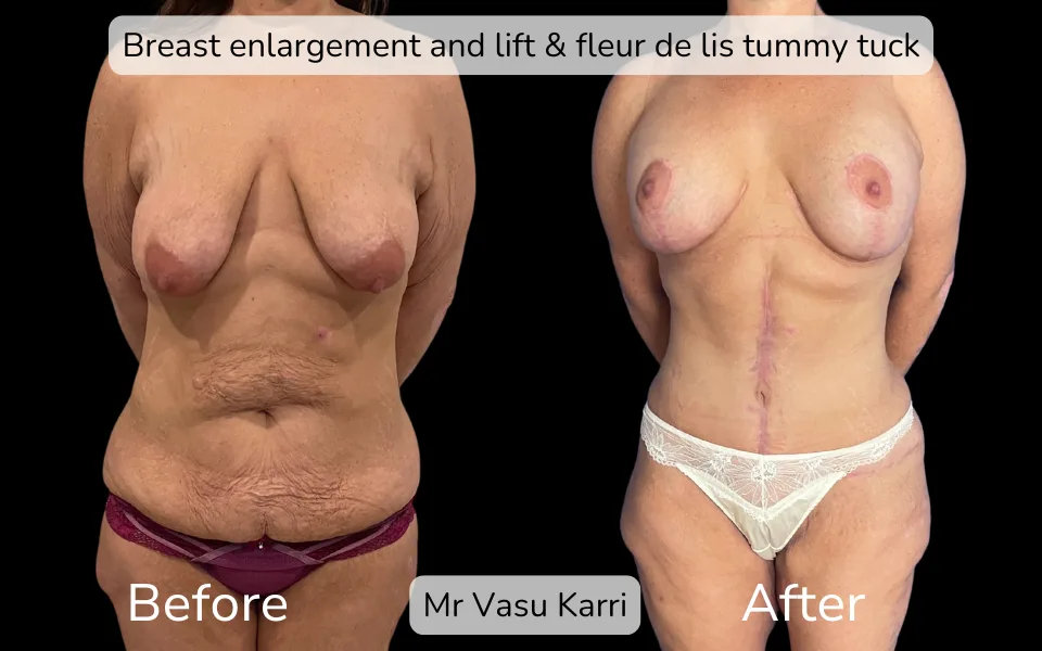 Before and after Mummy Makeover, patient 6