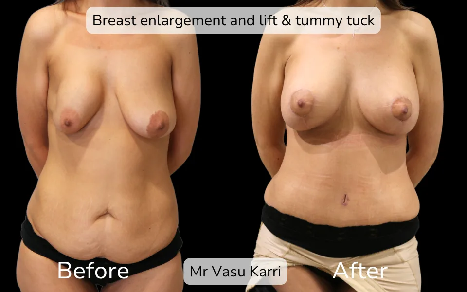 Before and after Mummy Makeover, patient 7