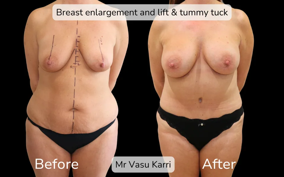Before and after Mummy Makeover, patient 8