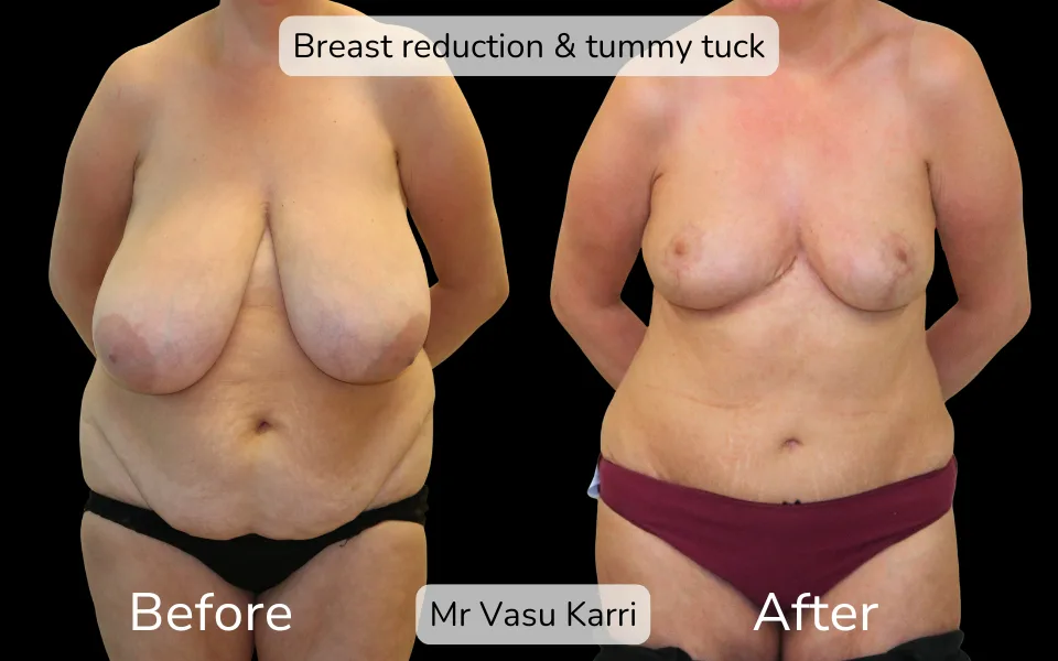 Before and after Mummy Makeover, patient 9
