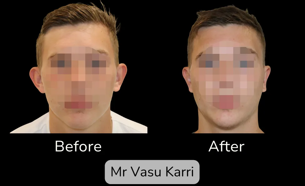 Before and after Prominent Ear Correction, patient 1