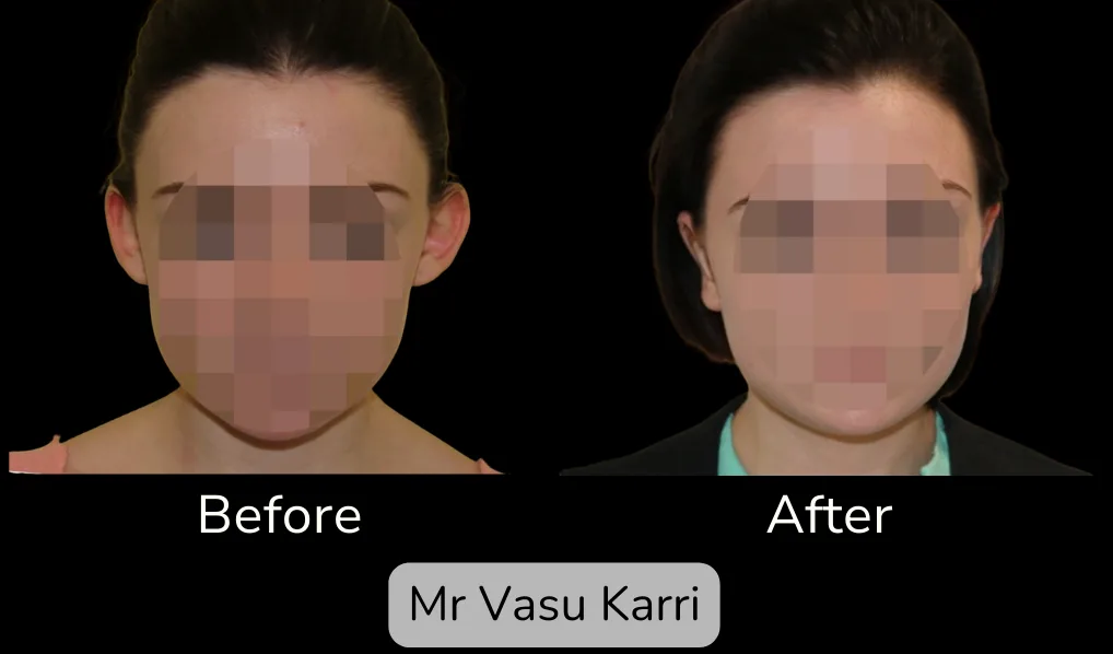 Before and after Prominent Ear Correction, patient 2