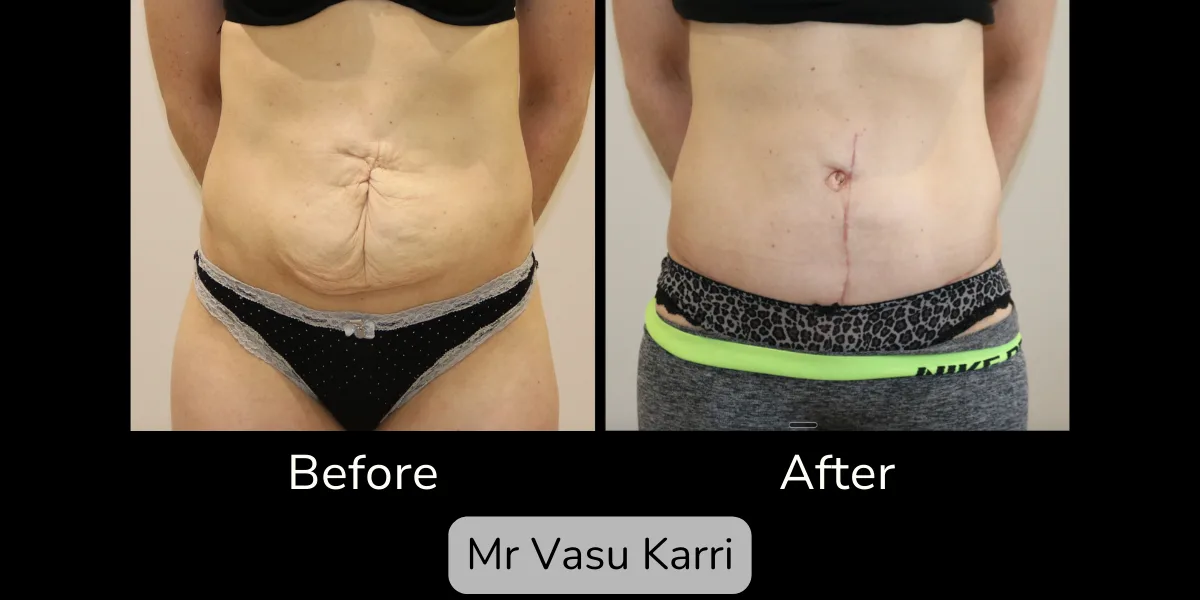 Before and after Scar Revision, patient 1