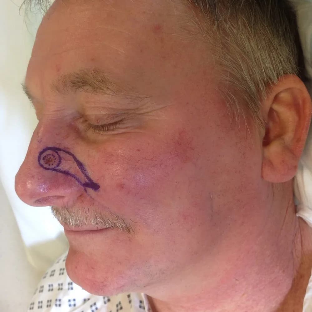 Before and after Skin Surgery, patient 6