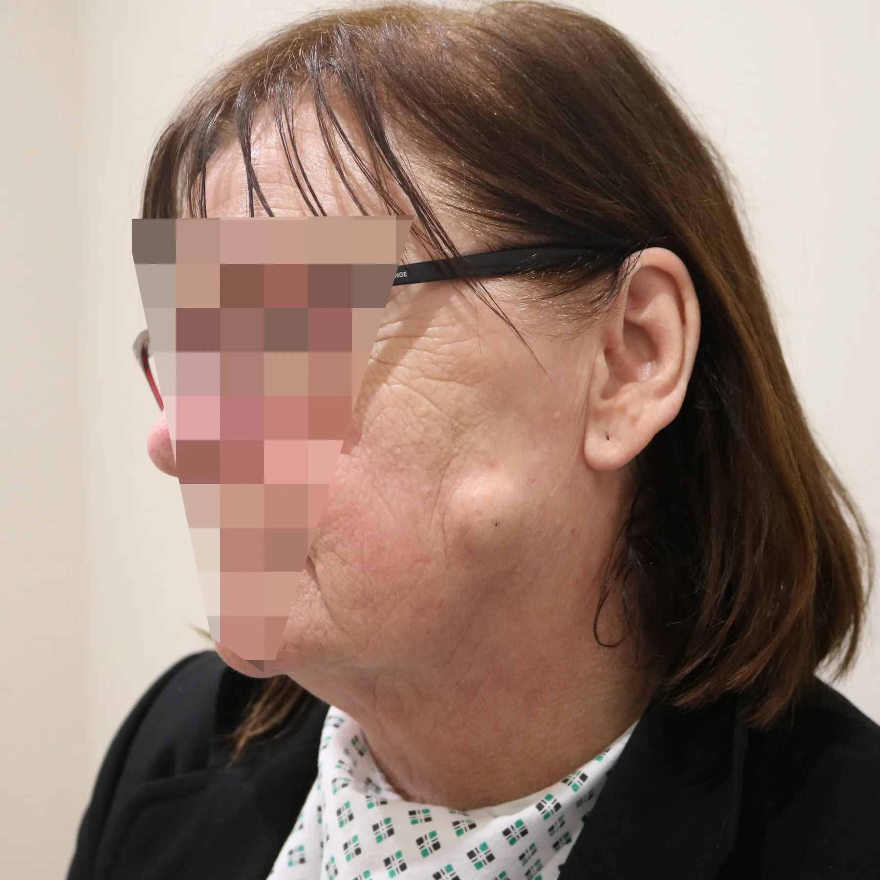 Before and after Skin Surgery, patient 1