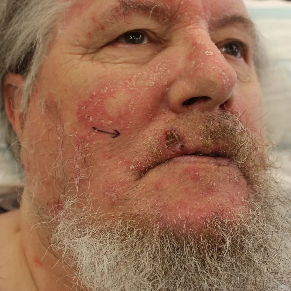 Before and after Skin Surgery, patient 10