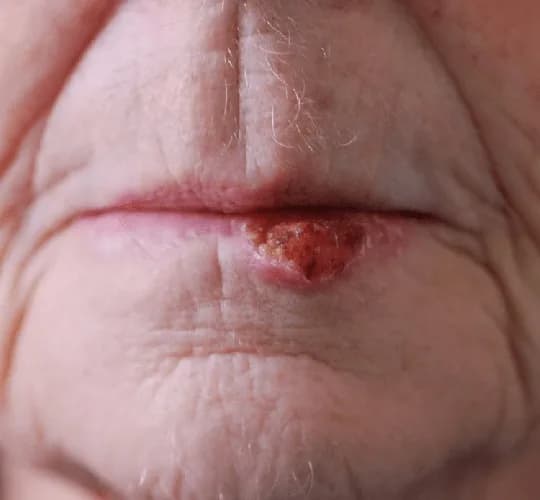 Before and after Skin Surgery, patient 11