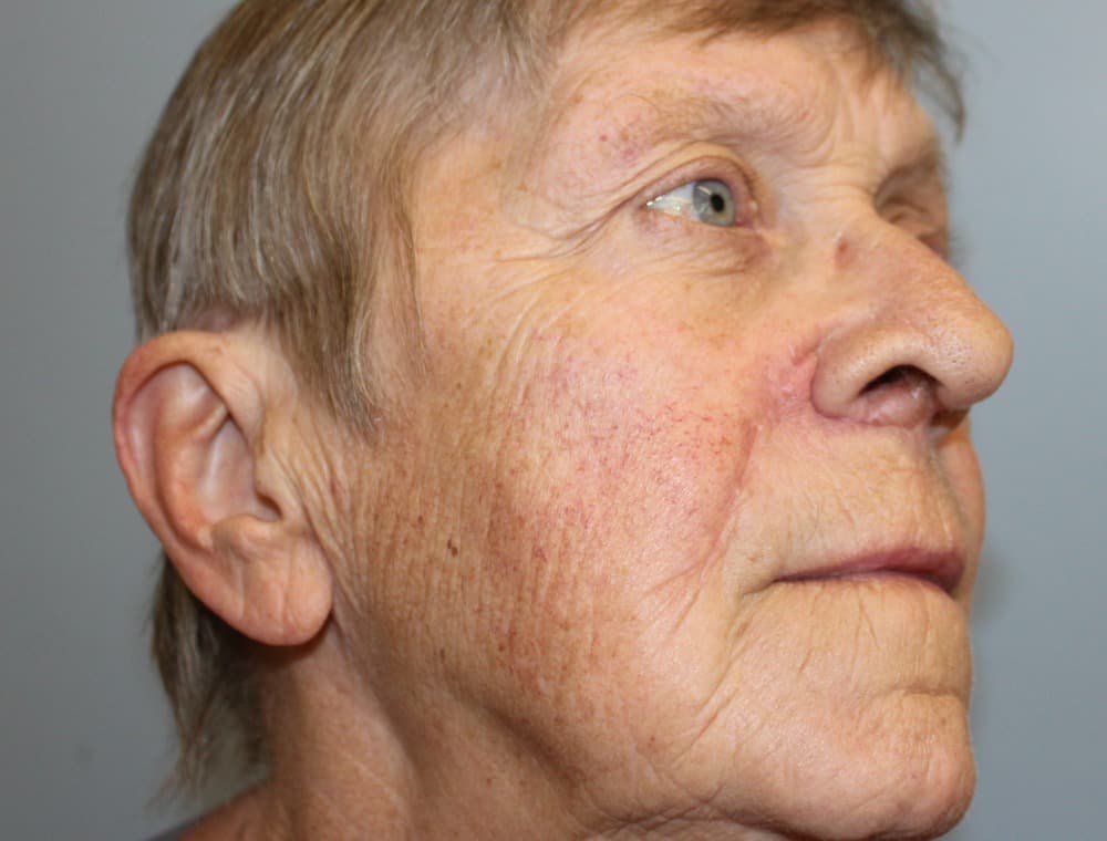 Skin Surgery before and after
