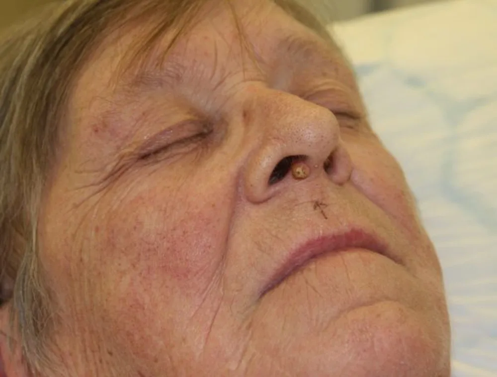 Before and after Skin Surgery, patient 2