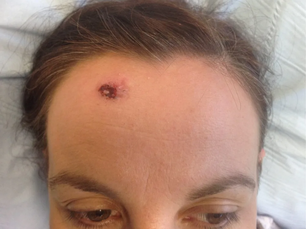 Before and after Skin Surgery, patient 3
