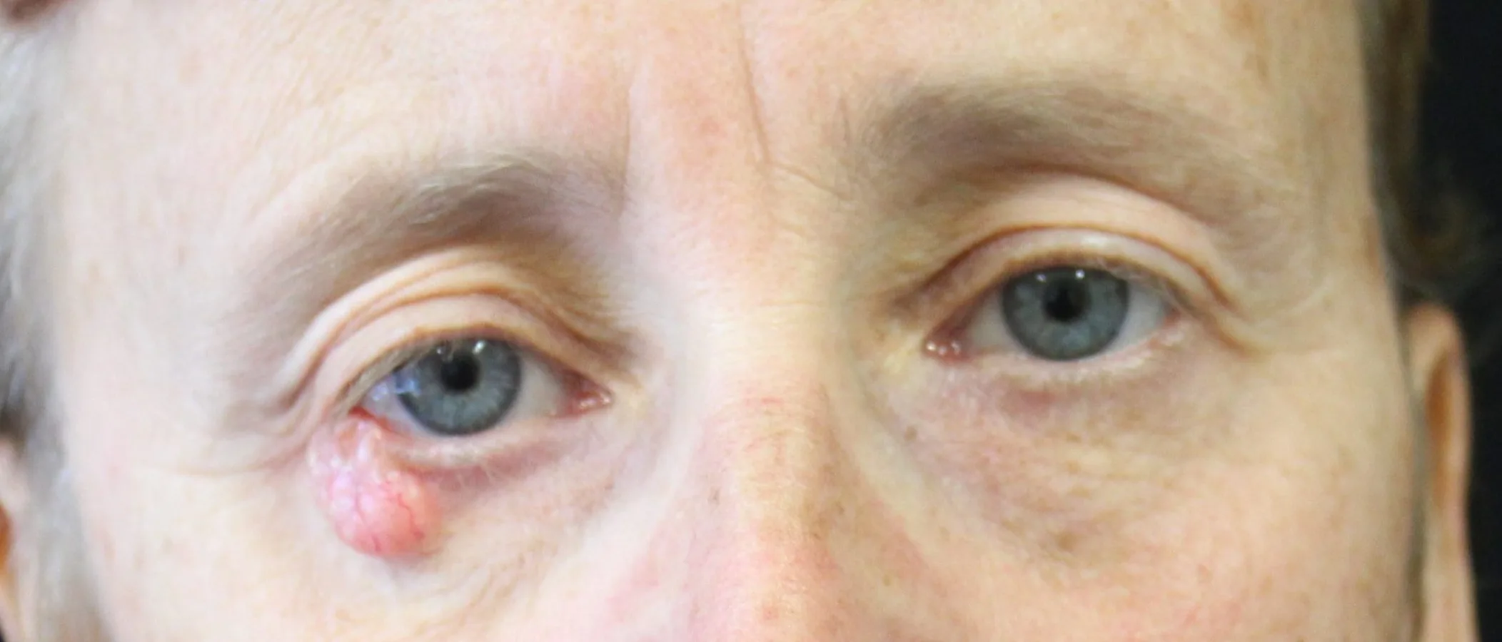 Before and after Skin Surgery, patient 4