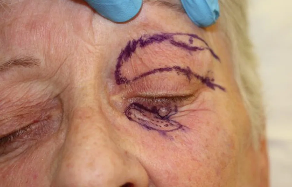 Before and after Skin Surgery, patient 5