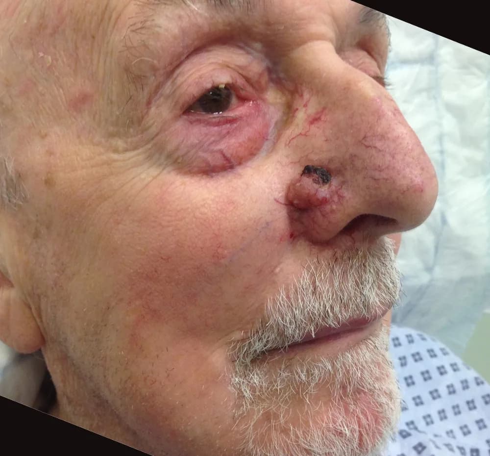 Before and after Skin Surgery, patient 7