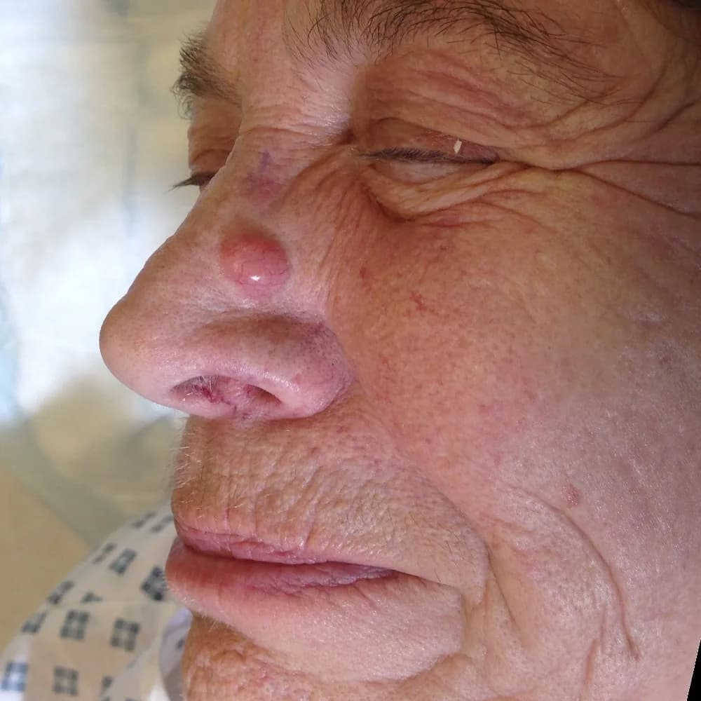 Before and after Skin Surgery, patient 8