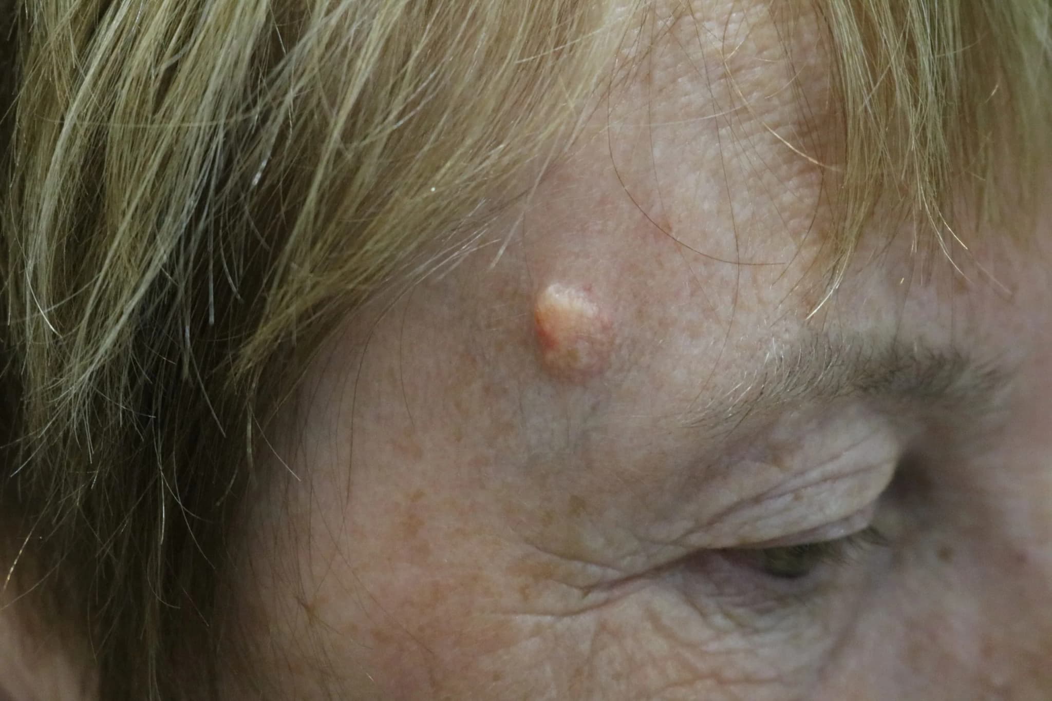 Before and after Skin Surgery, patient 9