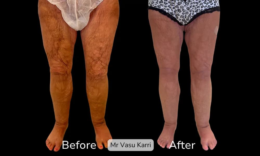Before and after Thigh Lift, patient 0.9