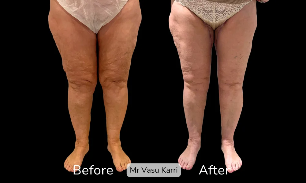 Before and after Thigh Lift, patient 1.5