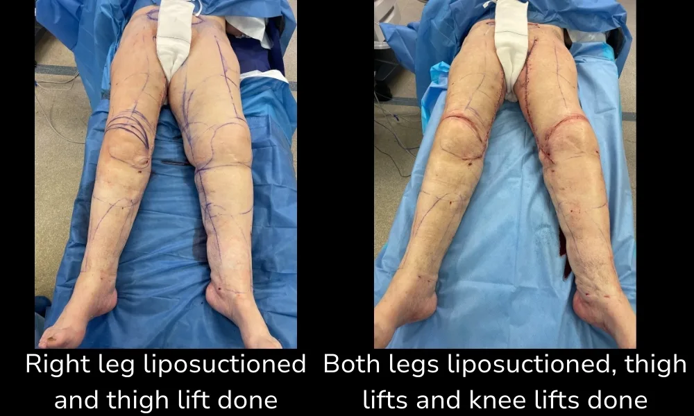 Before and after Thigh Lift, patient intra-1