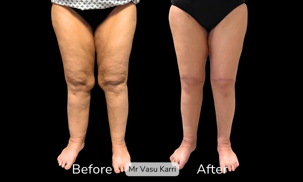 Before and after Thigh Lift, patient 8