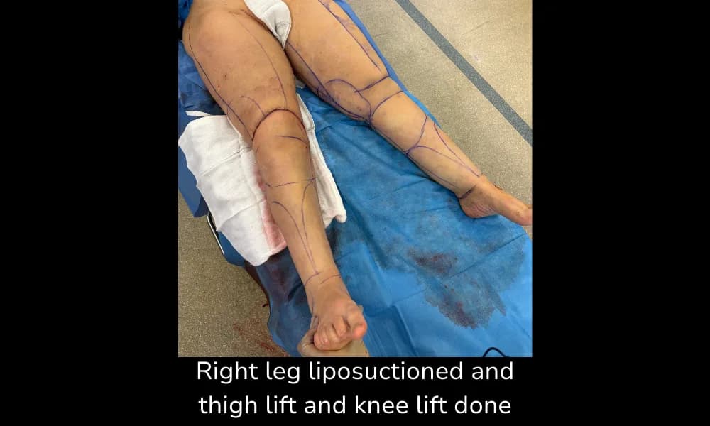 Before and after Thigh Lift, patient intra-4