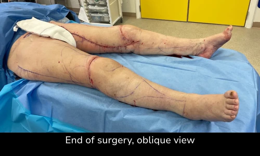 Before and after Thigh Lift, patient intra-2