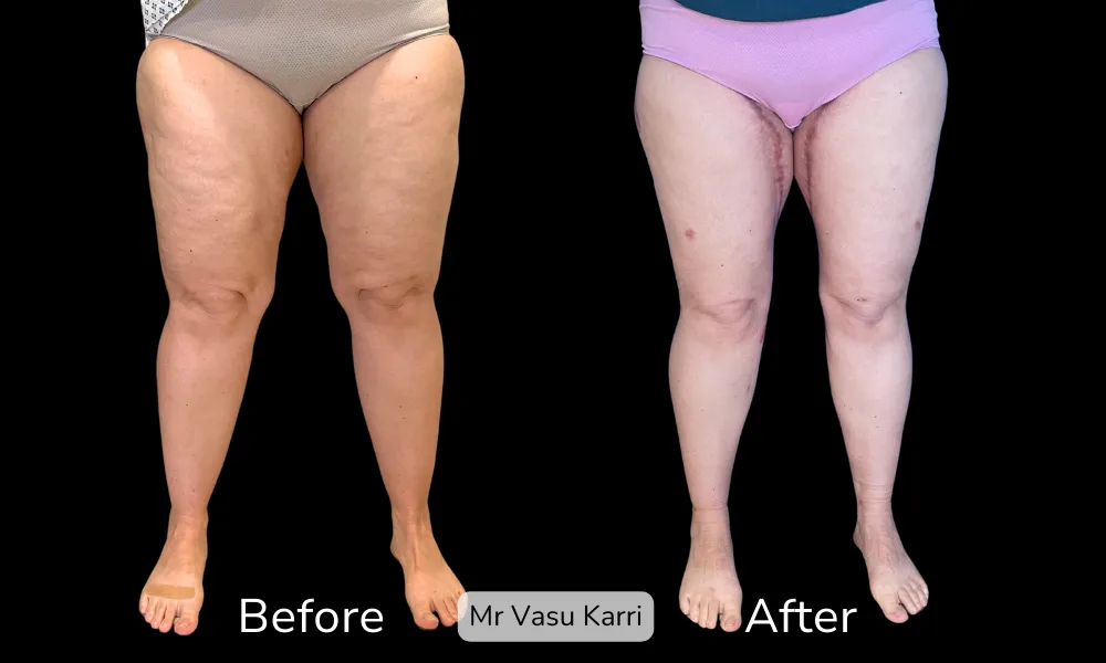Before and after Thigh Lift, patient 2