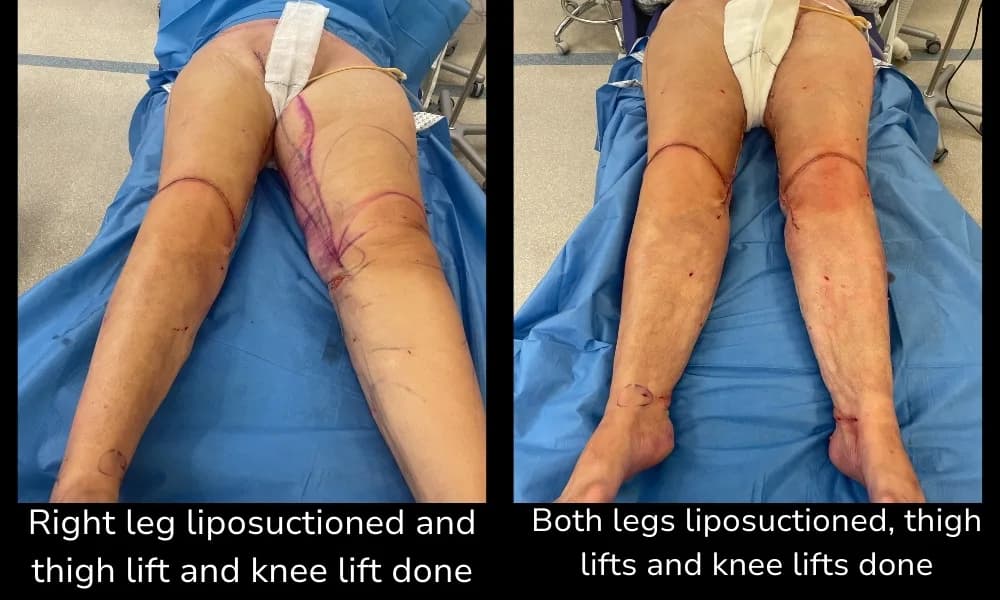 Before and after Thigh Lift, patient intra-3