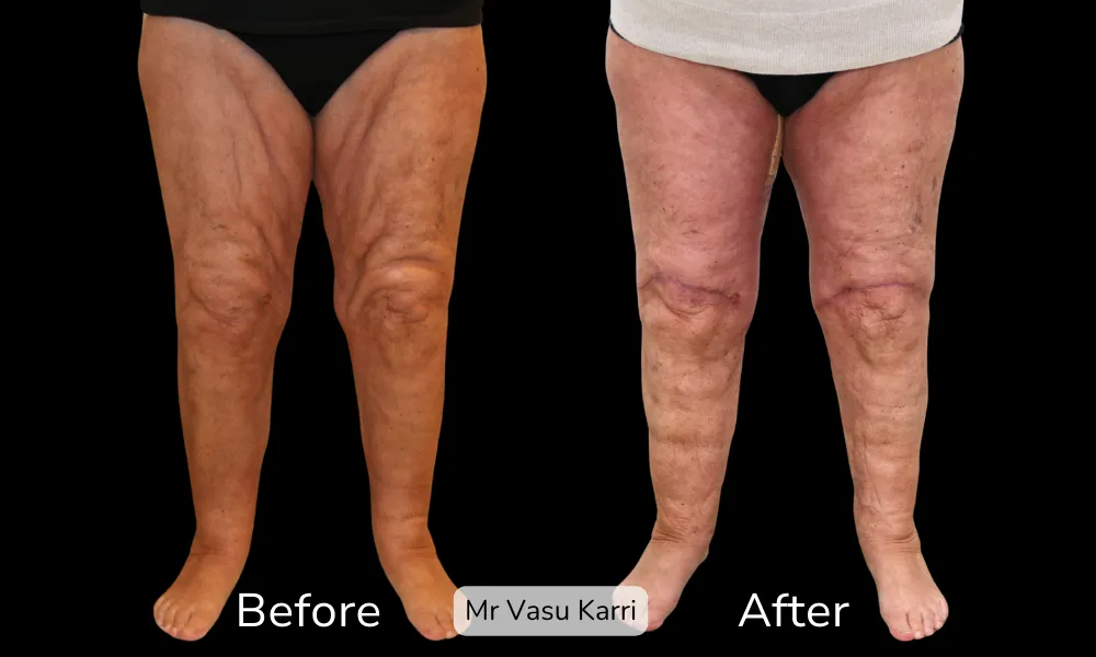 Before and after Thigh Lift, patient 3