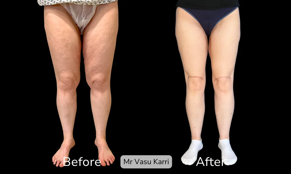 Before and after Thigh Lift, patient 4