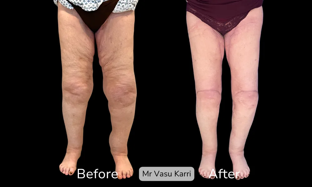Before and after Thigh Lift, patient 5