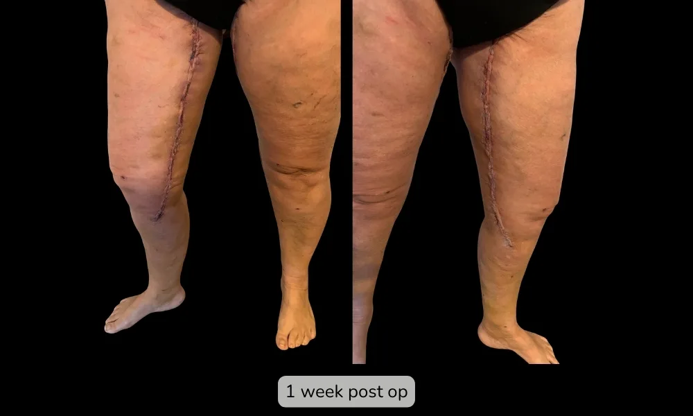 Before and after Thigh Lift, patient 6
