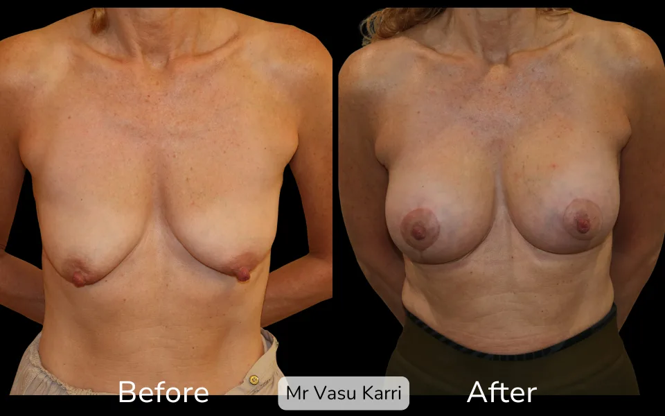 Before and after Tuberous Breast Surgery, patient 1