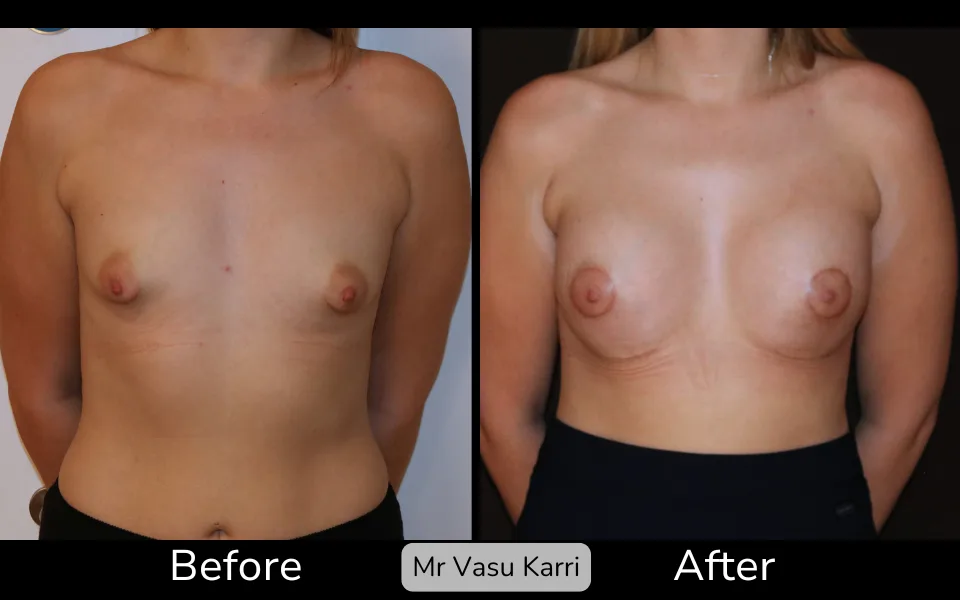Before and after Tuberous Breast Surgery, patient 2